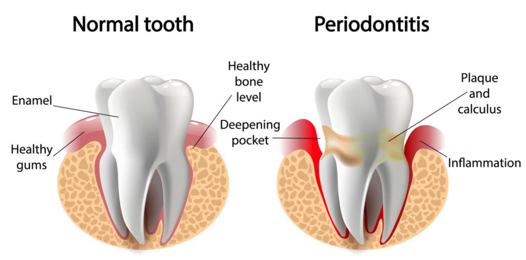 What Is Dental Plaque - Minovi Dental